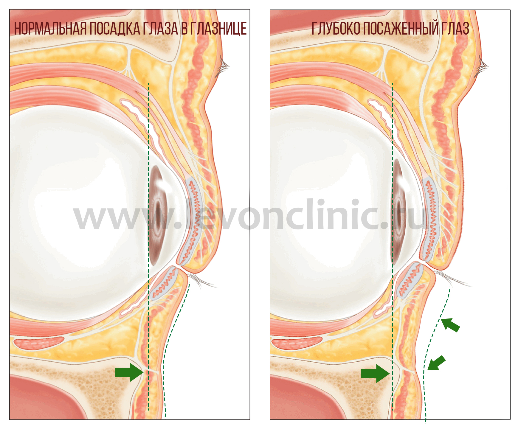 Тёмные круги и синяки под глазами - причины возникновения и методы коррекции