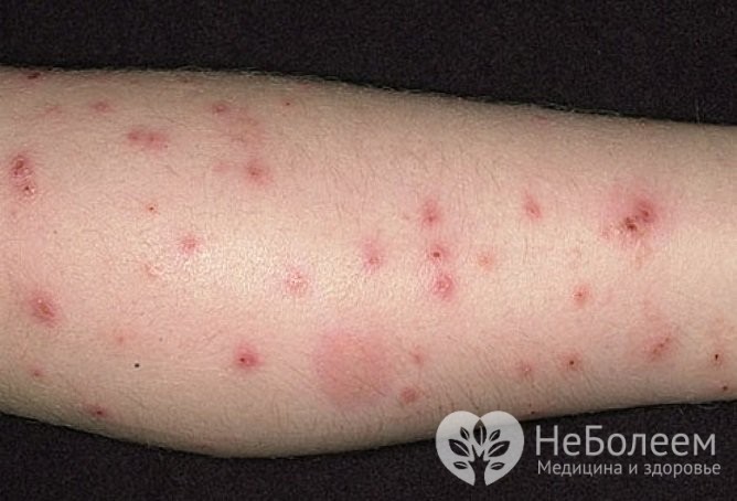 Укусы клопов обычно множественные, они имеют вид папул или везикул