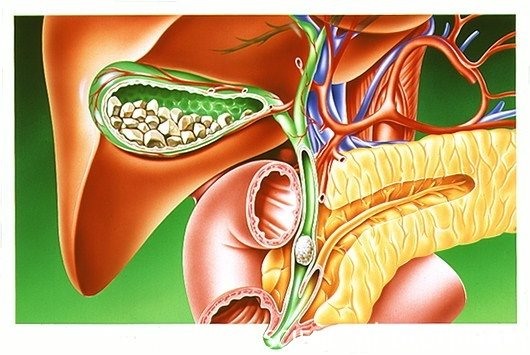 Желчекаменная болезнь
