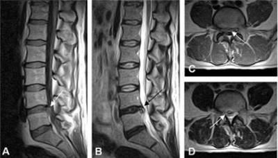 МРТ позвоночника МРТ позвоночника
