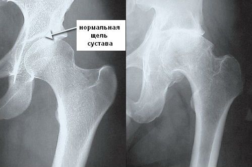 Остеосклероз тазобедренного сустава Остеосклероз тазобедренного сустава
