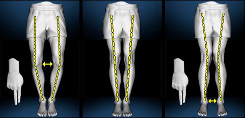 О- и Х-образная деформация голеней О- и Х-образная деформация голеней