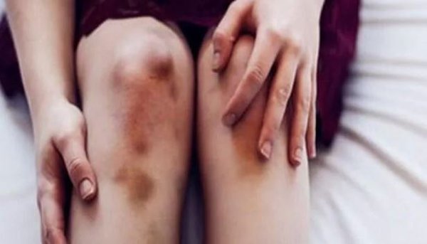 Более всего подвержены варикозу те, кто вынужден проводить на ногах большую часть дн Синяки на ногах? Это сигнал - примите меры. синяки на ногах