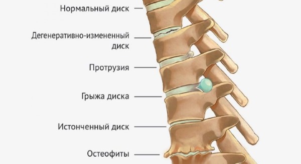 ЛФК при шейном остеохондрозе показана на всех стадиях развития заболевания