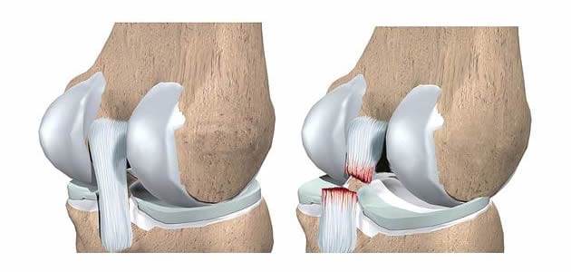 Разрыв задней крестообразной связки