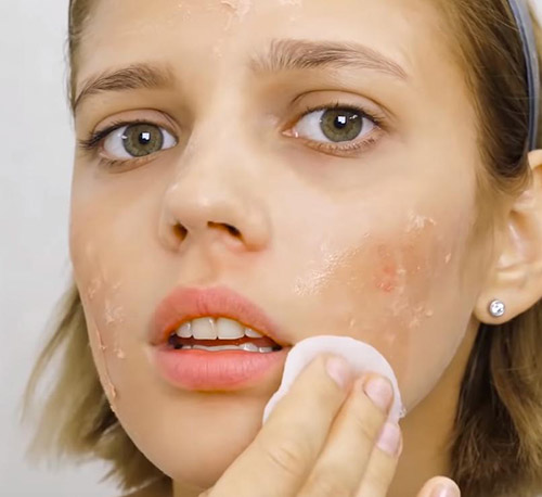 Состояние кожи после пилинга ТСА