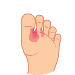 Межпальцевой грибок