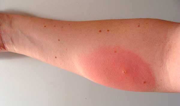 аллергия на укусы комаров