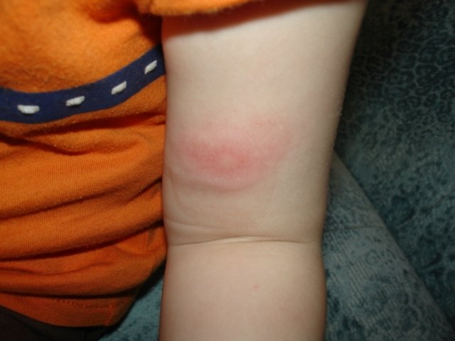 аллергия после укусов комаров