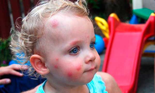 аллергия на укусы комаров у детей