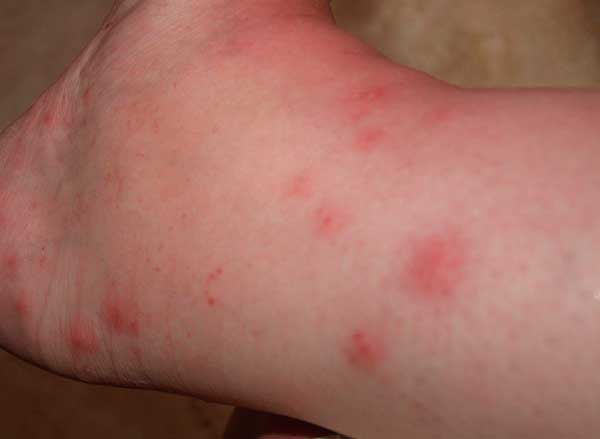 аллергия на укусы комаров