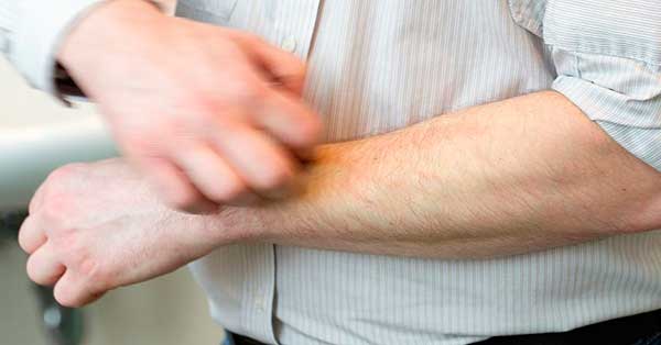 зуд от укуса мошки