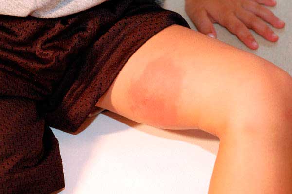 укусы мошек у детей