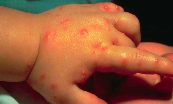 аллергия на укусы комаров у детей