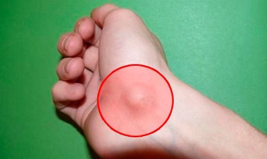 Воспаление суставной капсулы кисти называется бурситом Воспаление суставной капсулы кисти называется бурситом