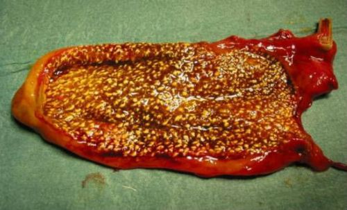 Холестеролоз