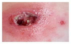 абсцесс после укола