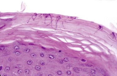 Corynebacterium minutissimum в роговом слое Corynebacterium minutissimum в роговом слое