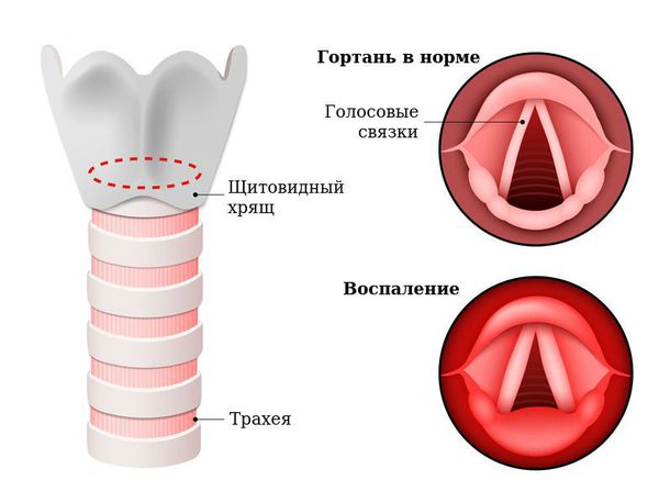 Воспаление слизистой оболочки гортани Воспаление слизистой оболочки гортани