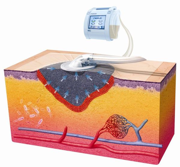 Вакуум-терапия