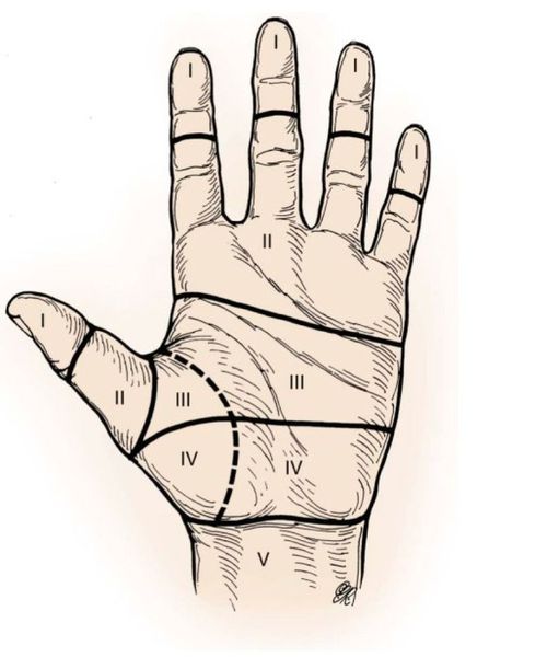 Зоны сухожилий кисти Зоны сухожилий кисти