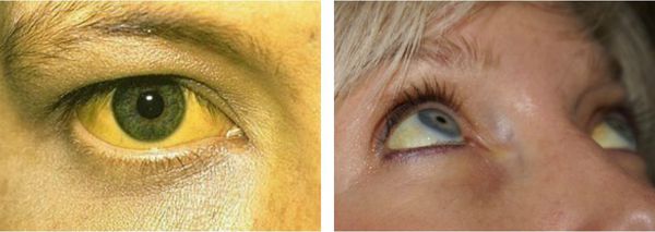 Желтизна склер