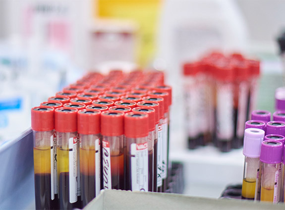 Анализ на вич-инфекции