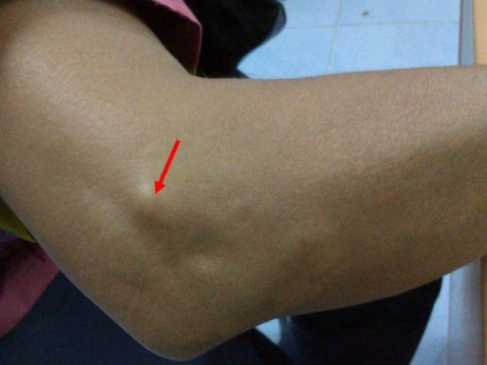 Остеофит локтевого отростка