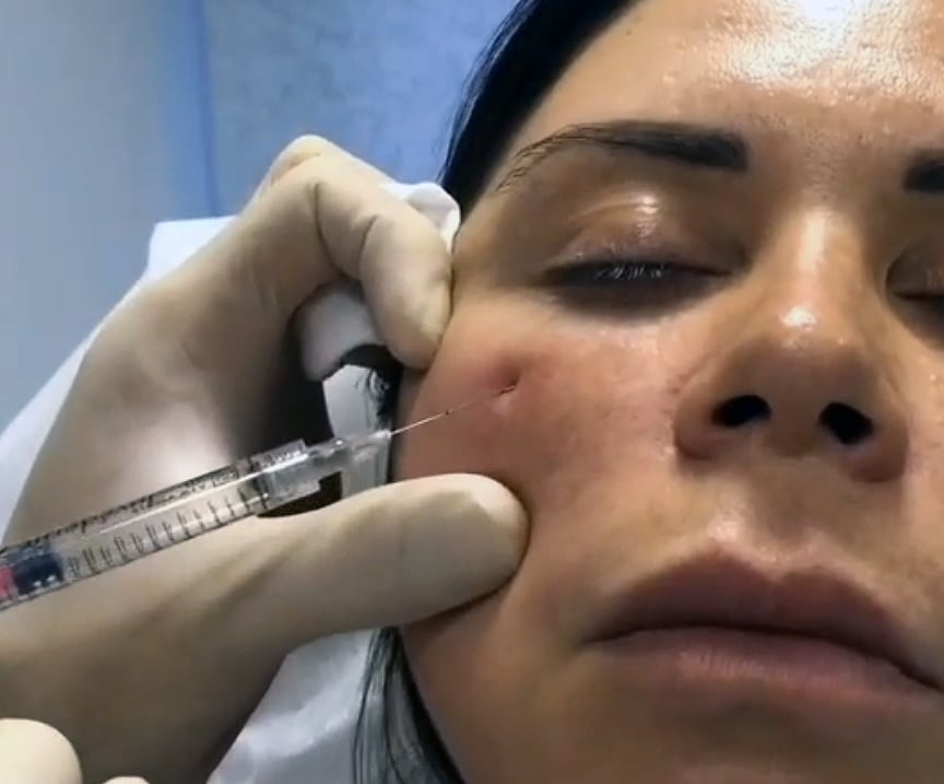 Как убрать тёмные круги под глазами