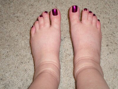 картинка с опухшими ногами