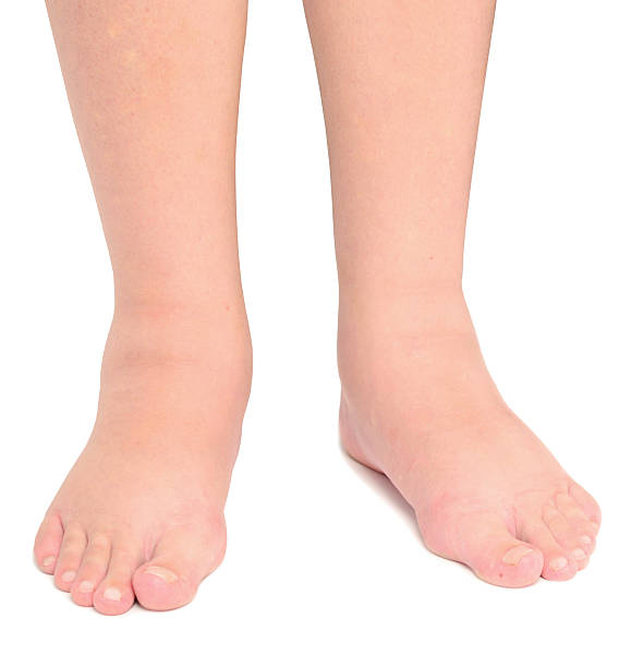 сердечные отеки на ногах