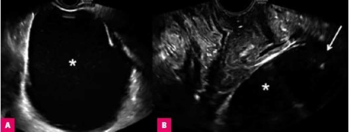 Ранние и поздние осложнения гинекологической хирургии: оценка в визуальных тестах