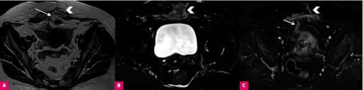 Ранние и поздние осложнения гинекологической хирургии: оценка в визуальных тестах