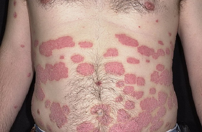 До сих пор причина псориаза точно не установлена Основные причины появления красных пятен на теле: