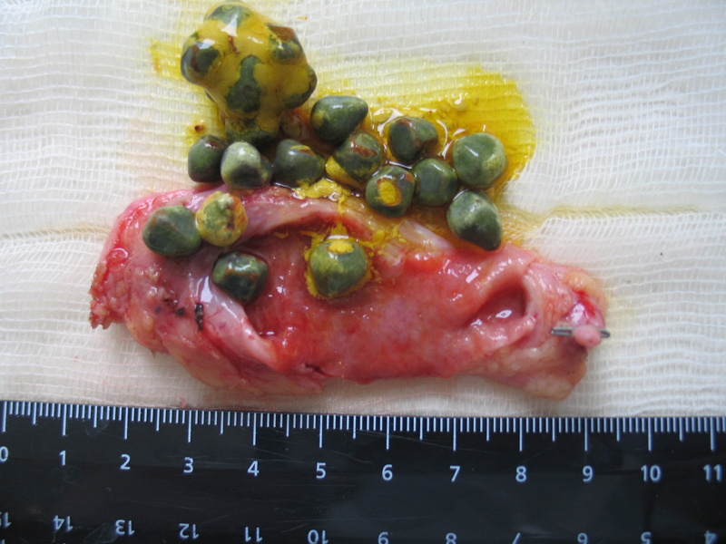 Холецистэктомия. Камни желчного пузыря Холецистэктомия. Камни желчного пузыря