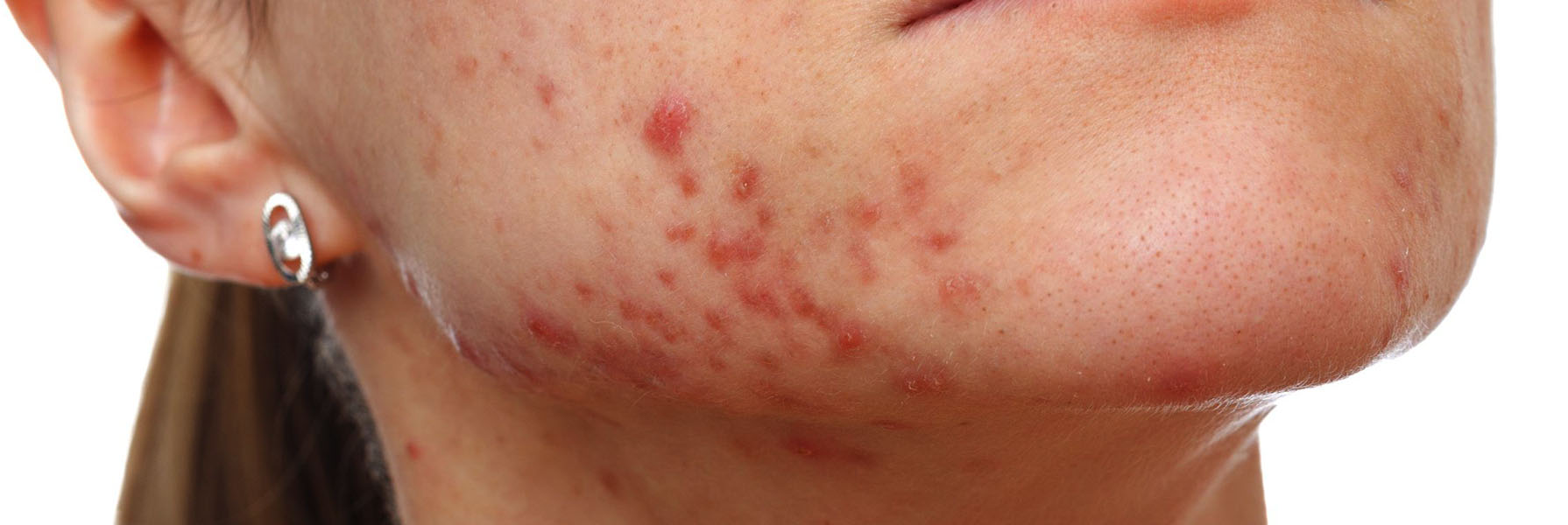 Фотография постакне Фото как выглядит постакне