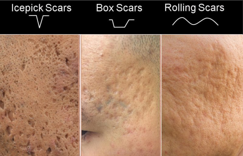 Виды шрамов от акне Виды постакне