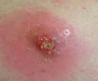 Постинъекционный абсцесс