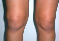 Синовит в коленном суставе Синовит в коленном суставе