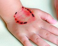 Укушенная рана Укушенная рана