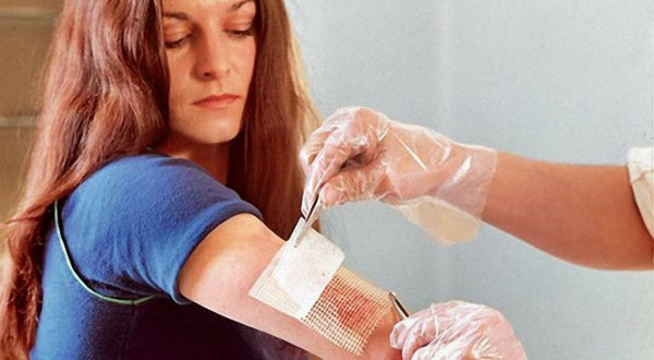 Перевязка при ожоге кожи Перевязка при ожоге кожи