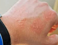 Отравление борной кислотой Отравление борной кислотой