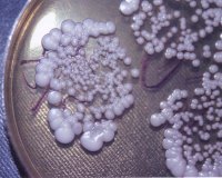 Кандидозный баланопостит Кандидозный баланопостит