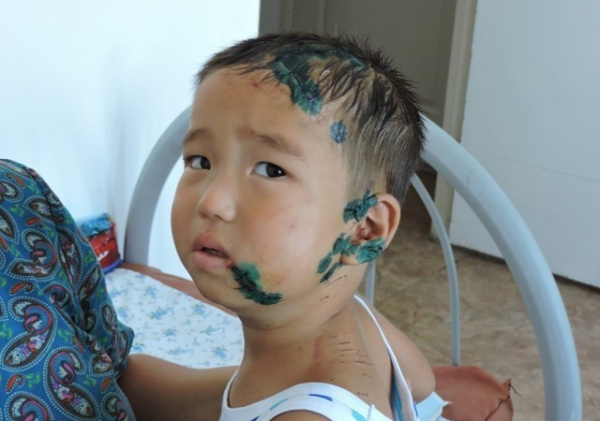 Укушенная рана Укушенная рана