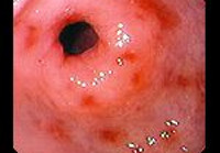 Антральный гастрит