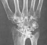 Остеосклероз Остеосклероз