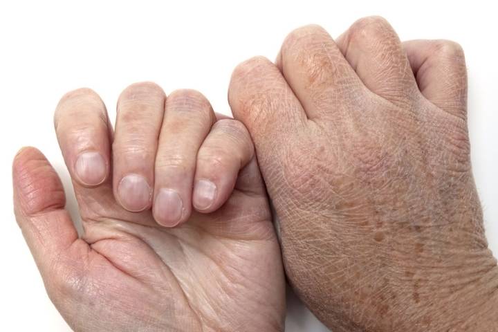 старческий зуд