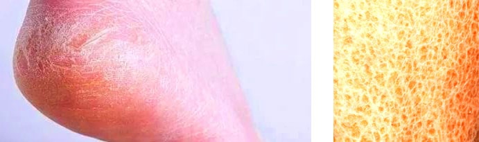 Ксероз кожи на стопах Ксероз кожи на стопах