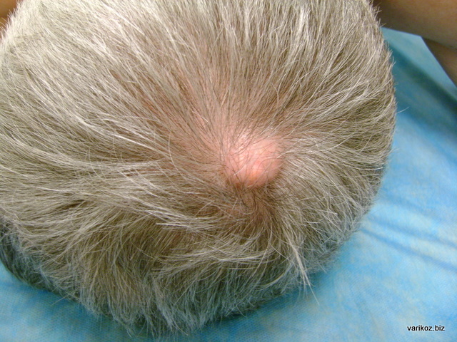 В чем разница между липомой и атеромой и нужно ли их удалять?