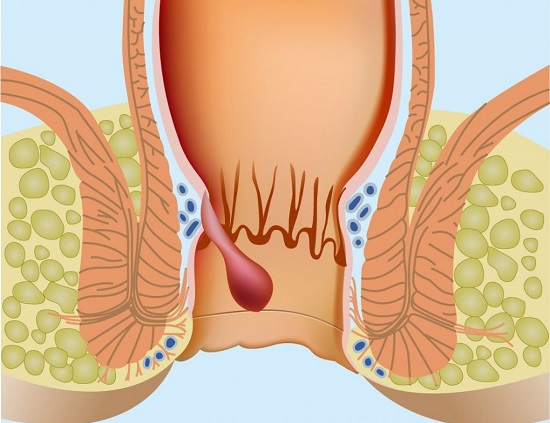 Анальный зуд при геморрое – решение проблемы